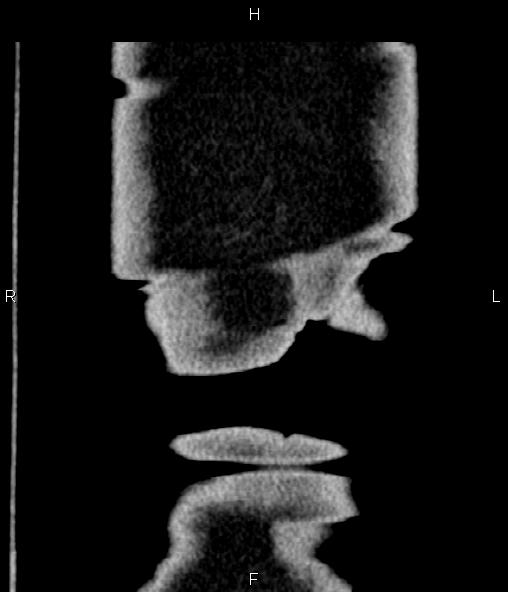 File:Adrenal myelolipoma (Radiopaedia 82742-96986 Coronal renal cortical phase 80).jpg