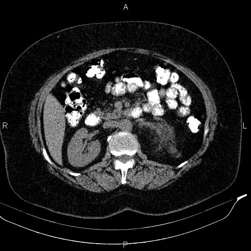 Adrenal myelolipoma (Radiopaedia 84319-99617 Axial With oral contrast 90).jpg