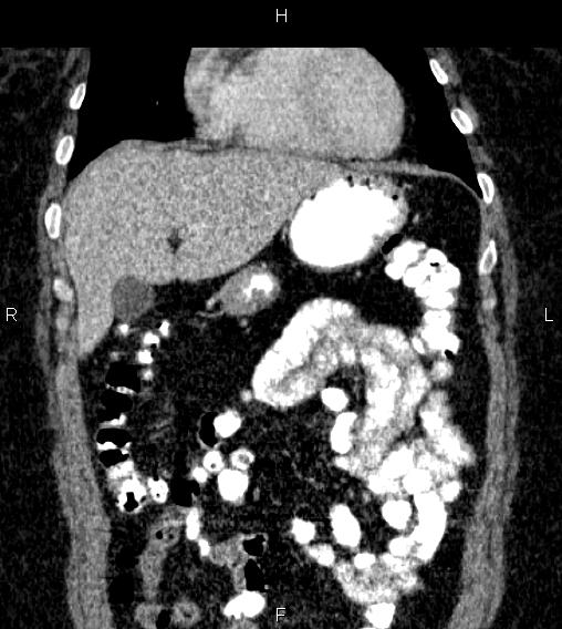 Adrenal myelolipoma (Radiopaedia 84319-99617 Coronal renal cortical phase 21).jpg