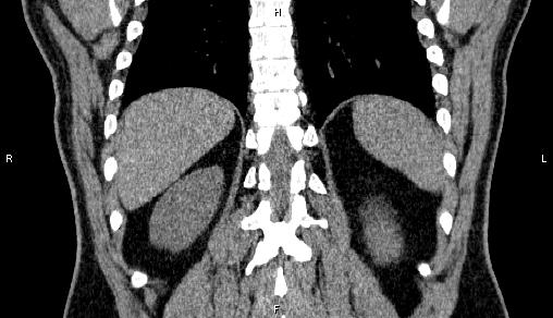 Adrenal myelolipoma (Radiopaedia 84321-99619 Coronal non-contrast 63).jpg
