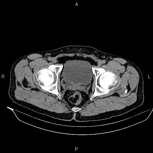 Adrenal myelolipoma (Radiopaedia 87794-104246 Axial non-contrast 102).jpg