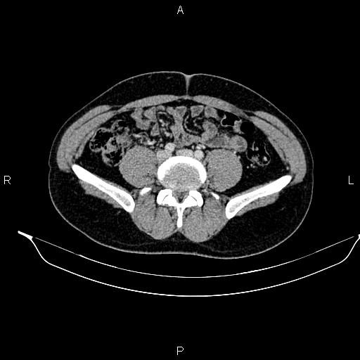 Adrenal myelolipoma (Radiopaedia 87794-104246 Axial renal cortical phase 70).jpg