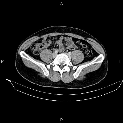 Adrenal myelolipoma (Radiopaedia 87794-104246 Axial renal cortical phase 74).jpg