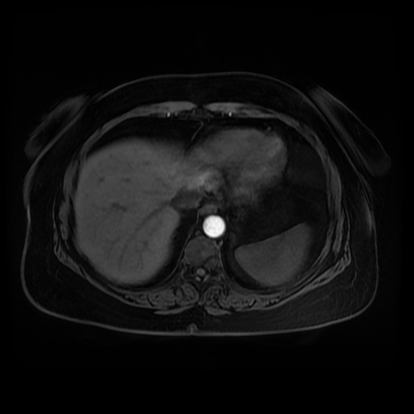 Adrenal myelolipoma - MRI (Radiopaedia 83249-97646 Axial T1 fat sat 2).jpg