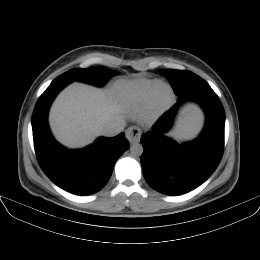 Adrenal myelolipoma - bilateral (Radiopaedia 74805-85810 Axial non-contrast 6).jpg