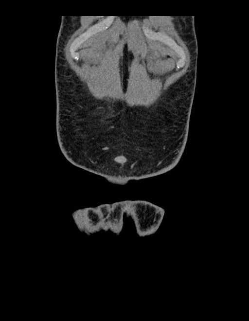 Adrenal myelolipoma - bilateral (Radiopaedia 74805-85810 Coronal C+ portal venous phase 250).jpg