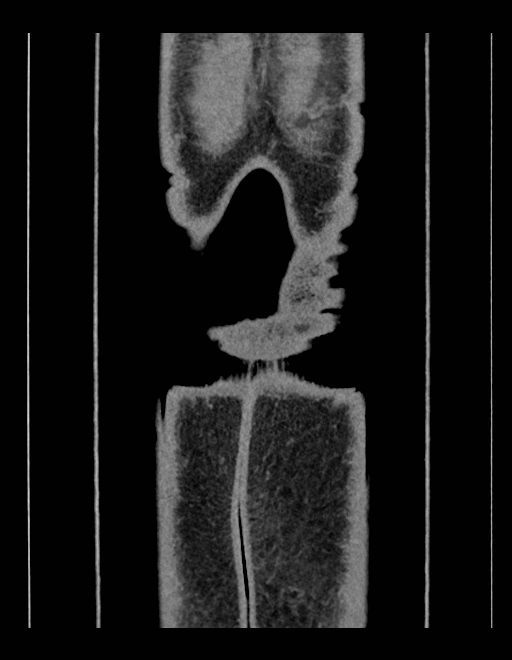 Adrenal myelolipoma - bilateral (Radiopaedia 74805-85810 Coronal C+ portal venous phase 28).jpg