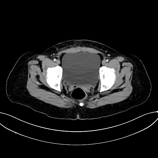 File:Adrenocortical carcinoma (Radiopaedia 87281-103569 Axial C+ portal venous phase 81).jpg