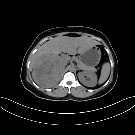 Adrenocortical carcinoma (Radiopaedia 87281-103569 Axial non-contrast 29).jpg