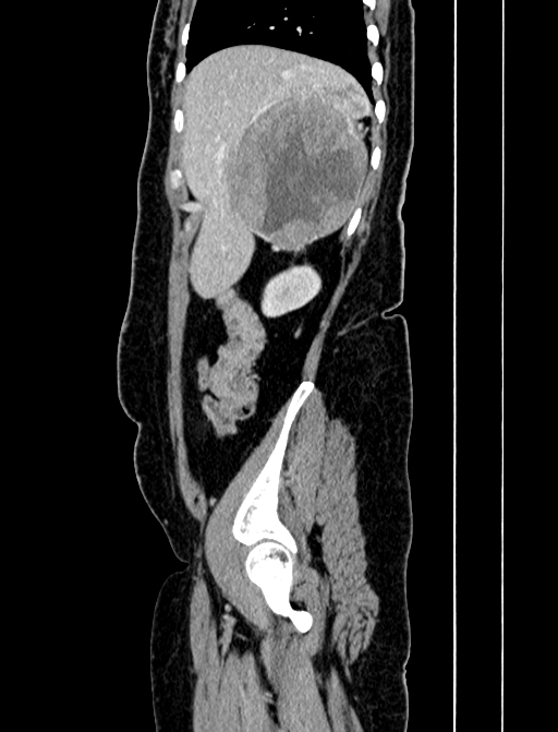 Adrenocortical carcinoma (Radiopaedia 87281-103569 Sagittal C+ portal venous phase 46).jpg