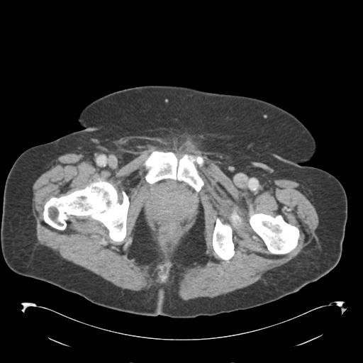 Adult ileal intussusception with secondary obstruction (Radiopaedia 30395-31051 Axial C+ portal venous phase 78).jpg
