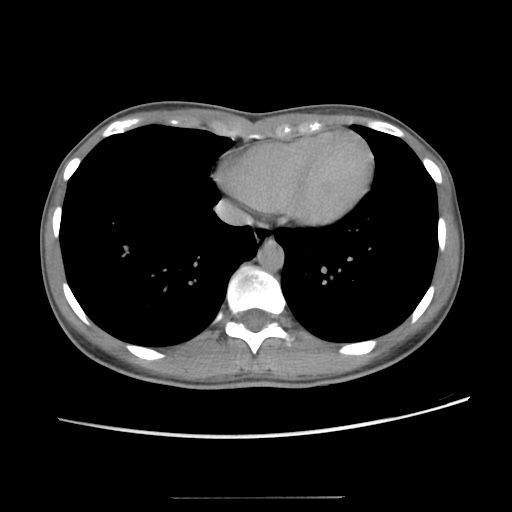 Adult polycystic kidney disease (Radiopaedia 48845-53876 Axial renal excretory phase 10).jpg