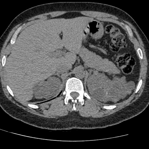 Adult polycystic kidney disease (Radiopaedia 59075-66368 Axial non-contrast 11).jpg