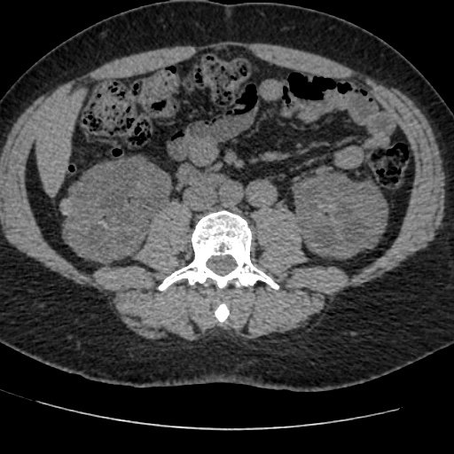 Adult polycystic kidney disease (Radiopaedia 59075-66368 Axial non-contrast 46).jpg