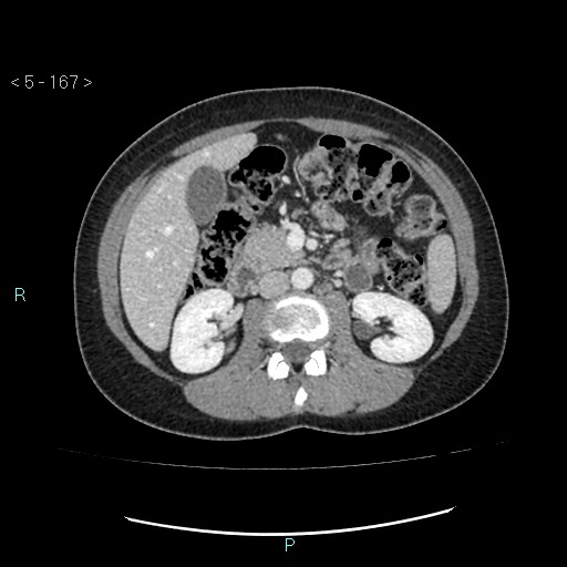 Adult transient intestinal intussusception (Radiopaedia 34853-36310 Axial C+ portal venous phase 24).jpg