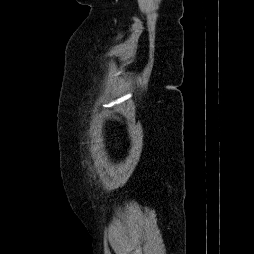 Afferent loop syndrome - secondary to incarcerated trocar site hernia (Radiopaedia 82959-97305 Sagittal C+ portal venous phase 146).jpg