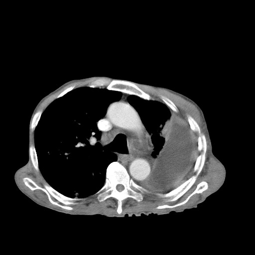 File:Aggressive lung cancer with cardiac metastases, pulmonary artery tumor thrombus, and Budd-Chiari (Radiopaedia 60320-67981 A 22).jpg
