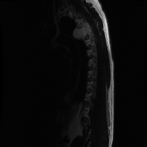 File:Aggressive vertebral hemangioma (Radiopaedia 39937-42404 Sagittal T2 2).png