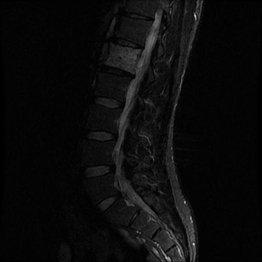 File:Aggressive vertebral hemangioma with pathological fracture (Radiopaedia 69528-79411 Sagittal STIR 4).jpg