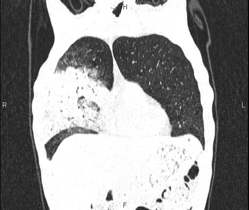 Air bronchogram in pneumonia (Radiopaedia 85719-101512 Coronal lung window 13).jpg