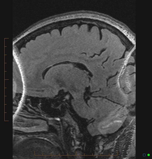 Aliasing artifact causing a spurious cerebellar lesion (Radiopaedia 48783-53810 Sagittal FLAIR 64).jpg