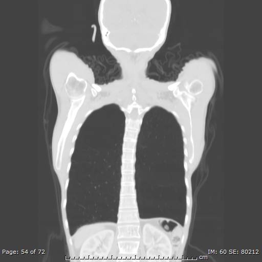 Alpha-1-antitrypsin deficiency (Radiopaedia 50561-55987 Coronal lung window 52).jpg