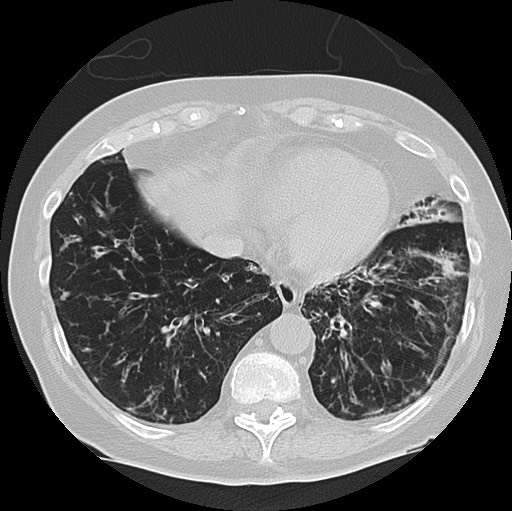 Alpha-1-antitrypsin deficiency (Radiopaedia 72058-82557 Axial lung window 54).jpg