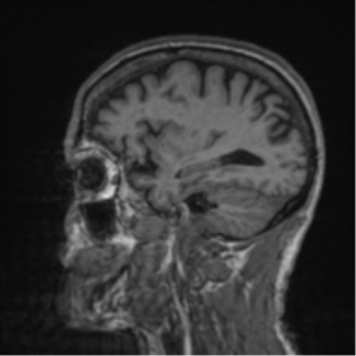 Alzheimer's disease- with apraxia (Radiopaedia 54763-61011 Sagittal T1 20).png
