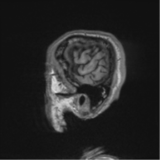 File:Alzheimer's disease- with apraxia (Radiopaedia 54763-61011 Sagittal T1 66).png