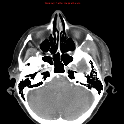 Ameloblastoma (Radiopaedia 27437-27631 A 6).jpg