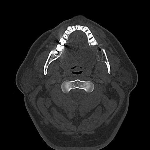Ameloblastoma (Radiopaedia 38520-40623 Axial bone window 29).png