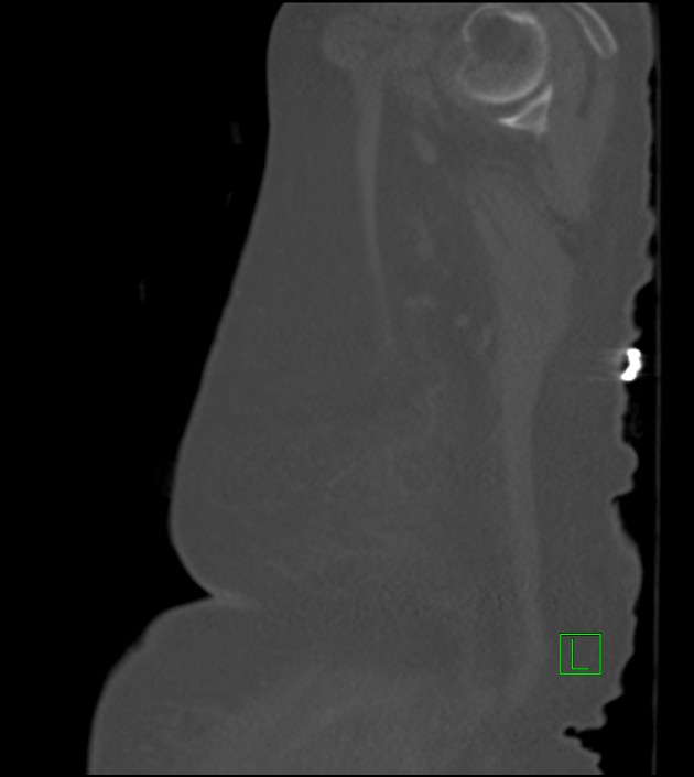 Amiodarone deposition in the liver (Radiopaedia 77587-89780 Sagittal bone window 11).jpg