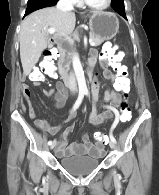 Ampullary adenocarcinoma (Radiopaedia 34013-35237 E 24).png