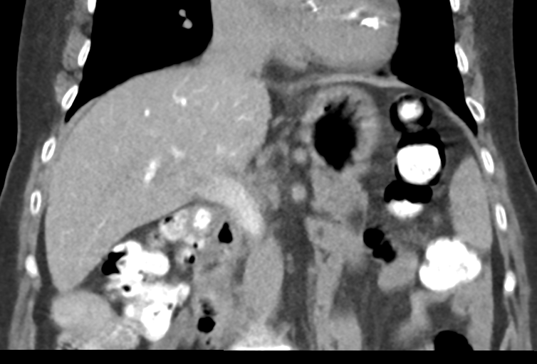 Ampullary adenocarcinoma (Radiopaedia 34013-35241 Coronal 24).png