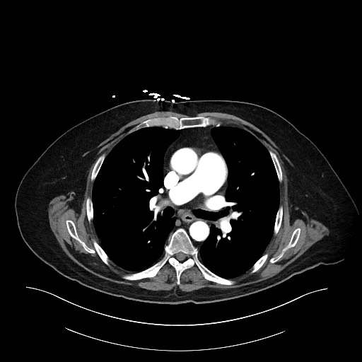 Ampullary adenocarcinoma (Radiopaedia 59373-66734 A 4).jpg