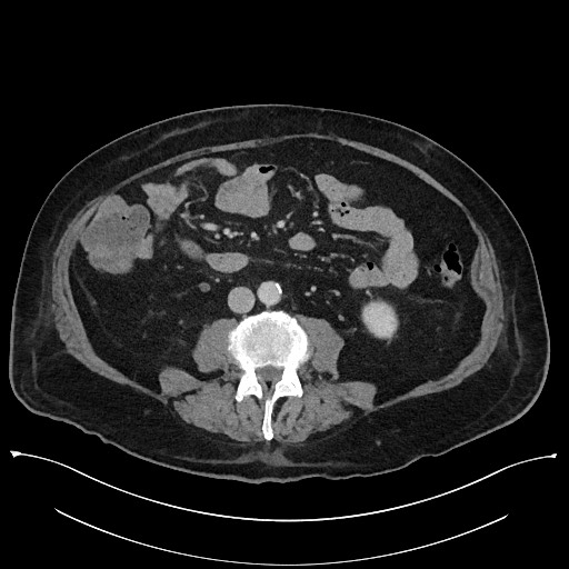Ampullary adenocarcinoma (Radiopaedia 59373-66737 A 94).jpg