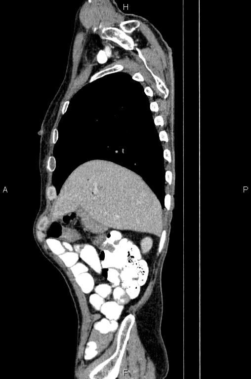 Ampullary adenocarcinoma (Radiopaedia 86093-102033 E 16).jpg