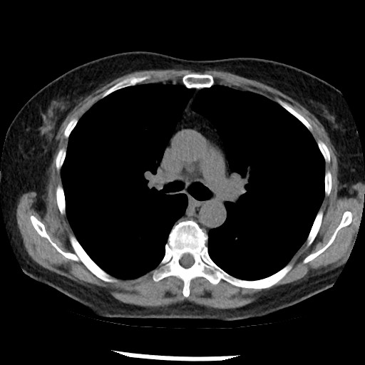 Amyloidosis - bronchial and diffuse nodular pulmonary involvement (Radiopaedia 60156-67744 Axial non-contrast 24).jpg