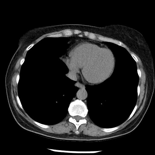 Amyloidosis - bronchial and diffuse nodular pulmonary involvement (Radiopaedia 60156-67744 Axial non-contrast 41).jpg
