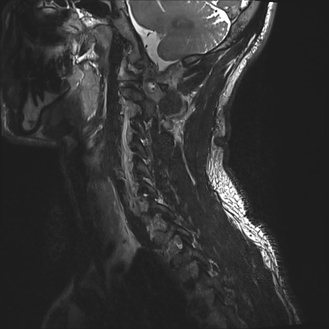 Amyotrophic lateral sclerosis (Radiopaedia 87352-103658 I 11).jpg