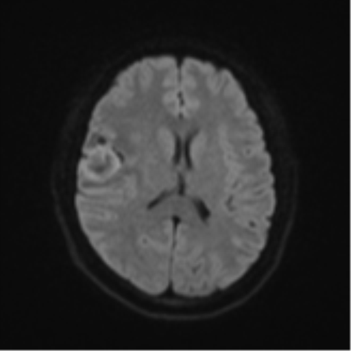 Anaplastic astroblastoma (Radiopaedia 55666-62194 Axial DWI 45).png