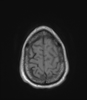 Anaplastic astrocytoma IDH wild-type (Radiopaedia 49984-55273 Axial T1 50).png