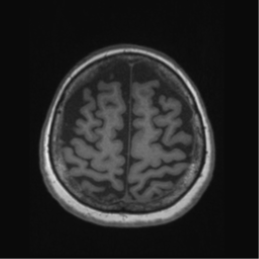 Anaplastic astrocytoma IDH wild-type (pseudoprogression) (Radiopaedia 42209-45276 Axial T1 121).png
