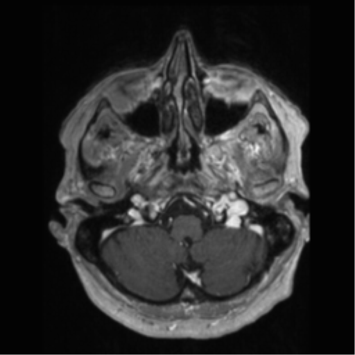 File:Anaplastic astrocytoma IDH wild-type (pseudoprogression) (Radiopaedia 42209-45277 Axial T1 C+ 16).png