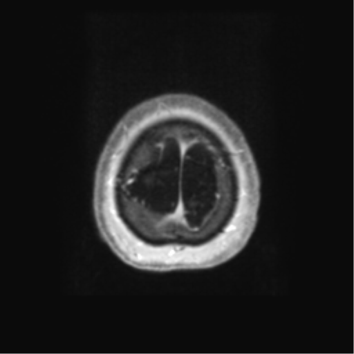 Anaplastic astrocytoma IDH wild-type (pseudoprogression) (Radiopaedia 42209-45279 Axial T1 C+ 134).png