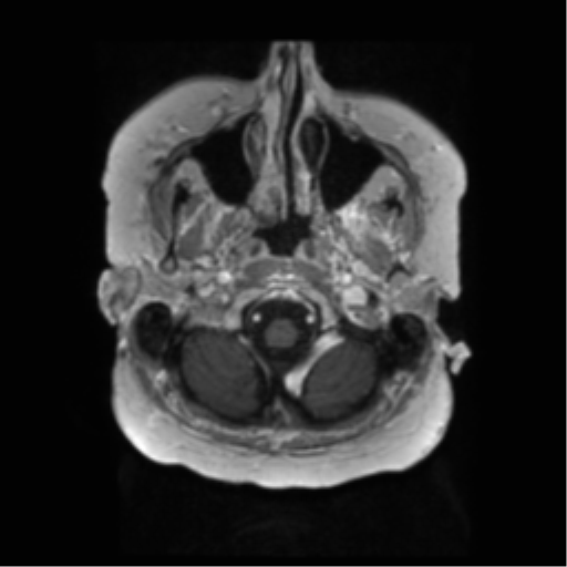 File:Anaplastic astrocytoma IDH wild-type (pseudoprogression) (Radiopaedia 42209-45279 Axial T1 C+ 17).png