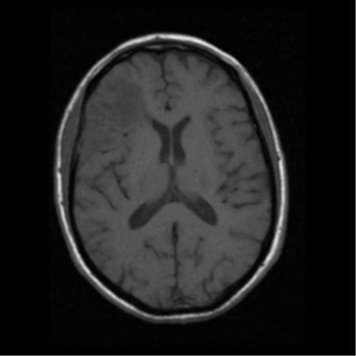 File:Anaplastic meningioma with recurrence (Radiopaedia 34452-35783 Axial T1 12).png