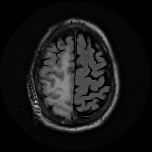 File:Anaplastic meningioma with recurrence (Radiopaedia 34452-35791 Axial FLAIR 18).png