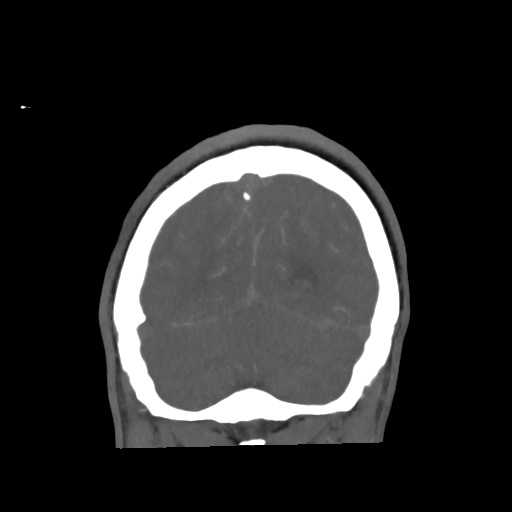 File:Aneursym related subarachnoid hemorrhage with hydrocephalus (Radiopaedia 45105-49084 B 69).jpg