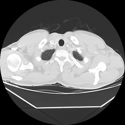 File:Aneurysmal bone cyst - rib (Radiopaedia 82167-96220 Axial lung window 12).jpg